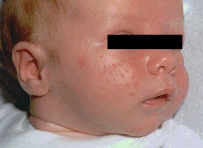 Baby Acne: Causes, Treatments, and More - Healthline
